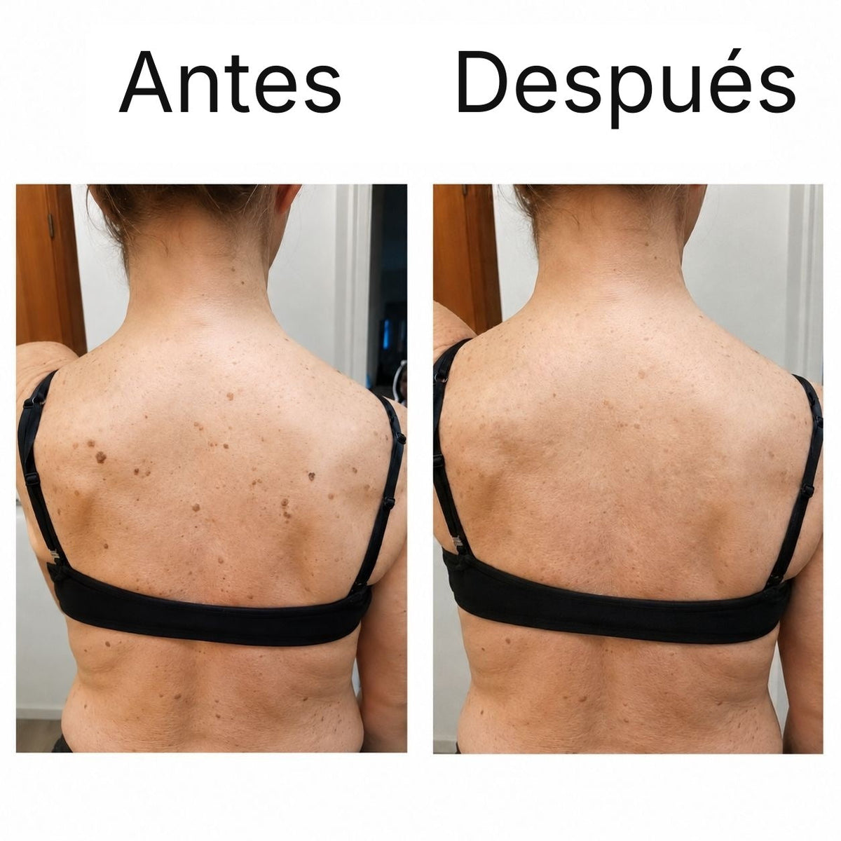 Antes y después en la espalda