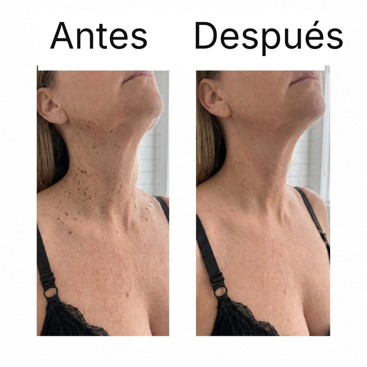 Antes y después en el cuello