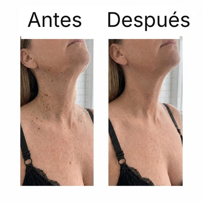 Antes y después en el cuello